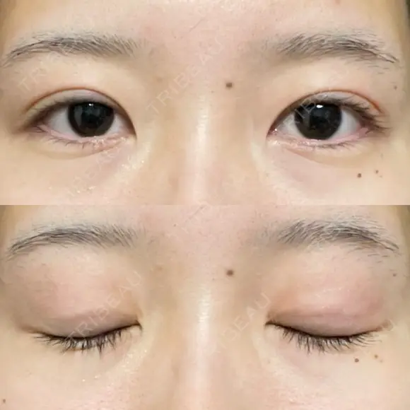 二重埋没 / 自然癒着法 シンデレラ＆ダヴィンチクリニック DAY 563 メイン用