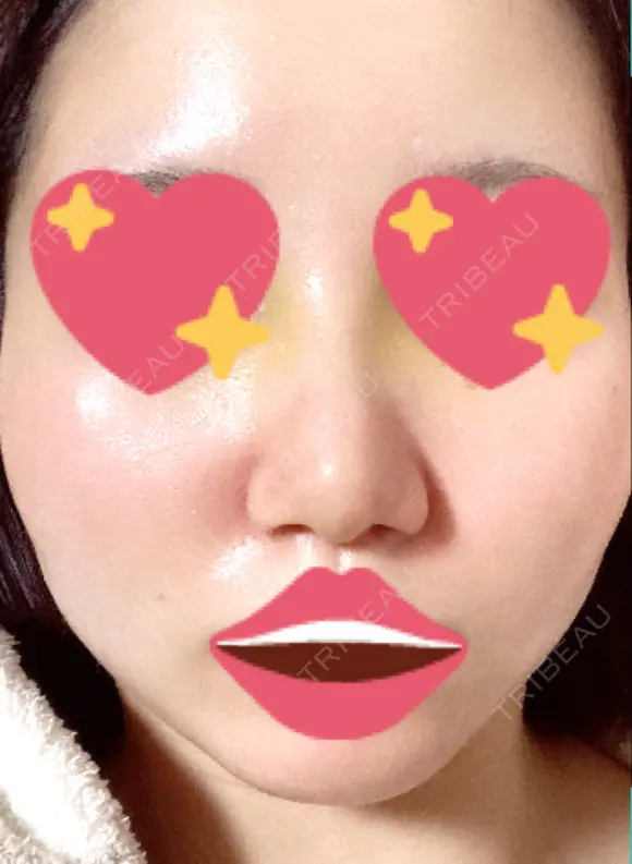 隆鼻術 / 軟骨移植 フェアクリニック川口 DAY 6 メイン用