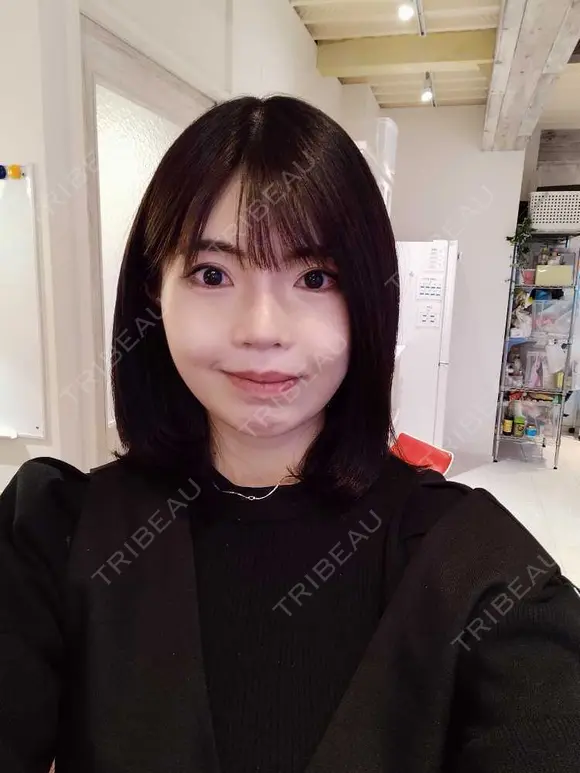 ルフォー+ssro（両あご) リッツ美容外科 東京院 DAY 25 メイン用