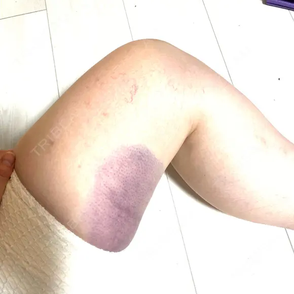 クマ治療 / ヒアルロン酸注入（額） あじまビューティークリニック DAY 0 メイン用