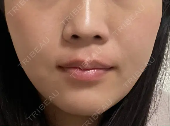 小鼻縮小（非切開） AI Beauty Clinic （エーアイ美容クリニック） DAY 3 メイン用
