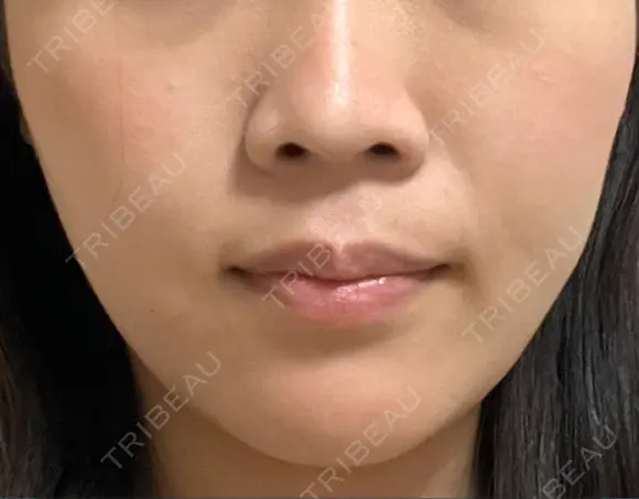 小鼻縮小（非切開） AI Beauty Clinic （エーアイ美容クリニック） DAY 5 メイン用