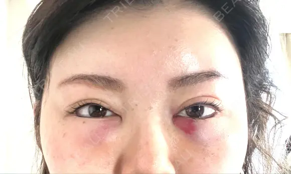 クマ治療 / ヒアルロン酸注入（額） あじまビューティークリニック DAY 1 メイン用