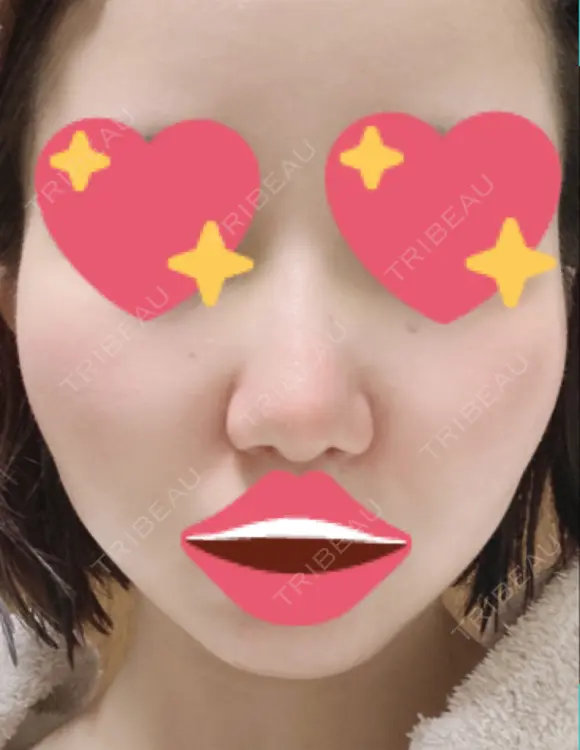 隆鼻術 / 軟骨移植 フェアクリニック川口 DAY 10 メイン用