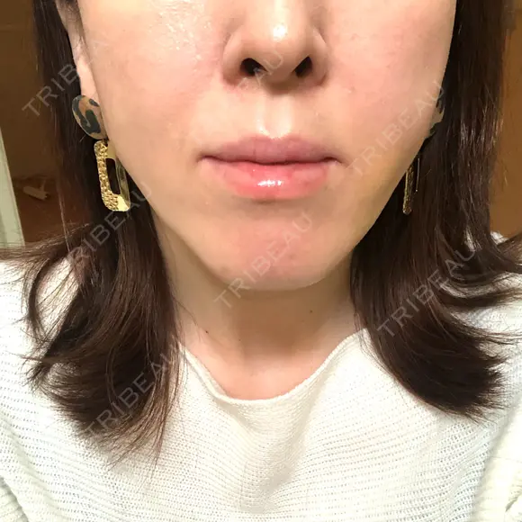 糸リフト ノーチェビューティクリニック DAY 8 メイン用