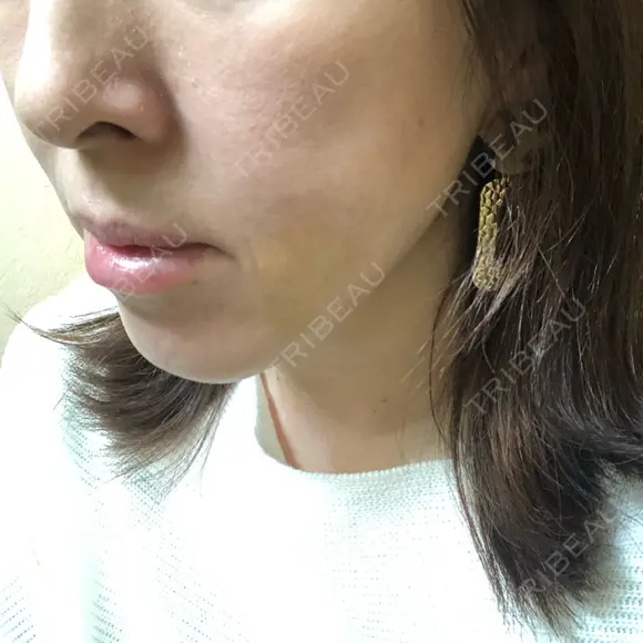 糸リフト ノーチェビューティクリニック DAY 8 メイン用