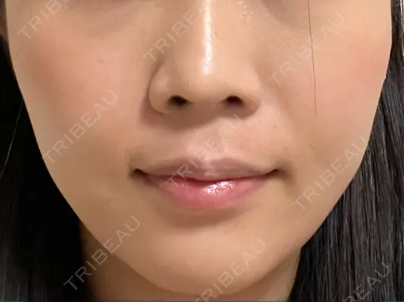 小鼻縮小（非切開） AI Beauty Clinic （エーアイ美容クリニック） DAY 8 メイン用