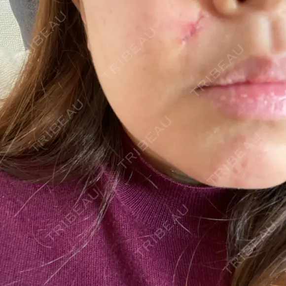 ほくろ・いぼ切除（肌） LIKI CLINIC KOBE AFTER メイン用