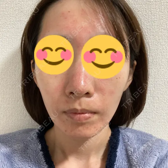 ヴェルヴェットスキン 新宿西口TAKUMI美容クリニック（シンジュクニシグチタクミビヨウクリニック) DAY 0 メイン用
