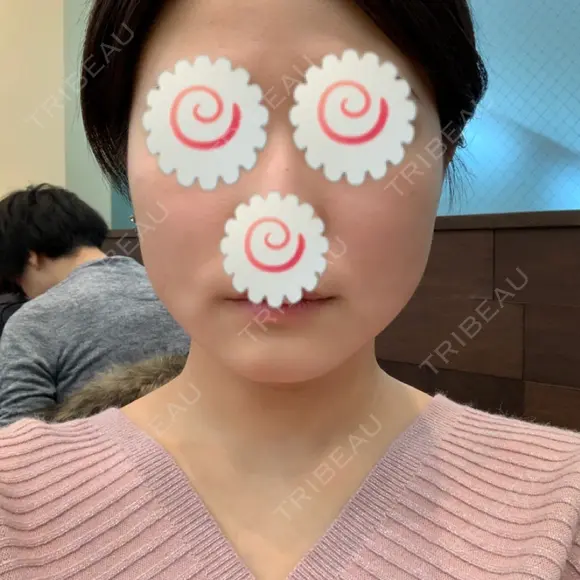 脂肪溶解注射（顔） 聖心美容クリニック 福岡院 DAY 4 メイン用