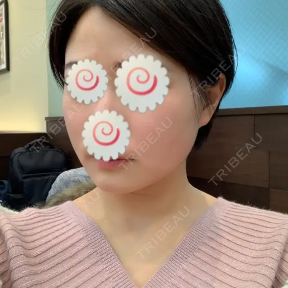 脂肪溶解注射（顔） 聖心美容クリニック 福岡院 DAY 4 メイン用