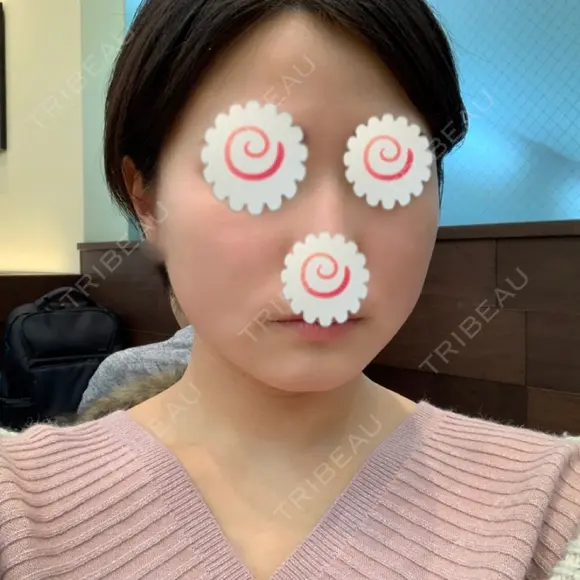 脂肪溶解注射（顔） 聖心美容クリニック 福岡院 DAY 4 メイン用