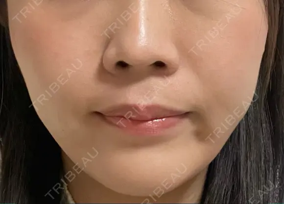 小鼻縮小（非切開） AI Beauty Clinic （エーアイ美容クリニック） DAY 9 メイン用