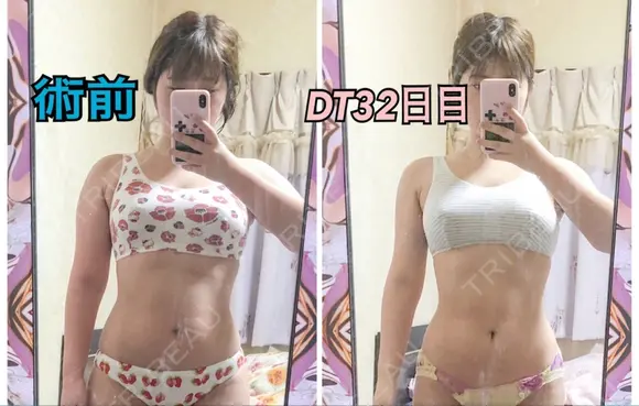 脂肪吸引（二の腕） ドクターフィット（Dr.fit）クリニック AFTER メイン用