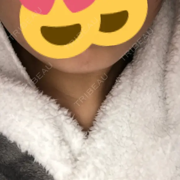 ボトックス（エラ・小顔） STARS CLINIC AFTER メイン用