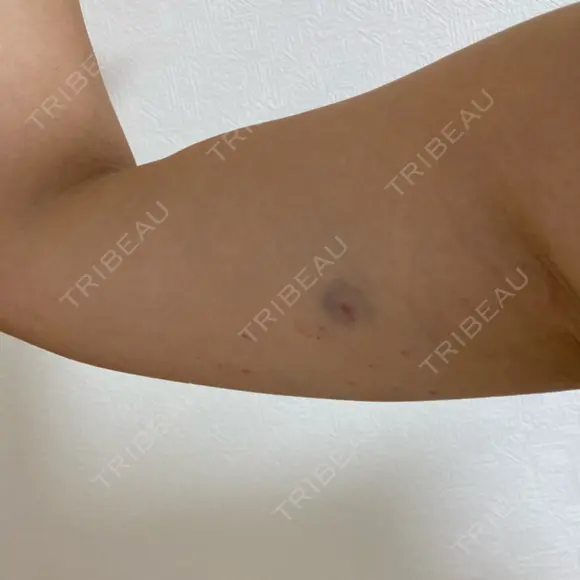 脂肪溶解注射（二の腕） 石倉クリニック 水戸院 DAY 14 メイン用