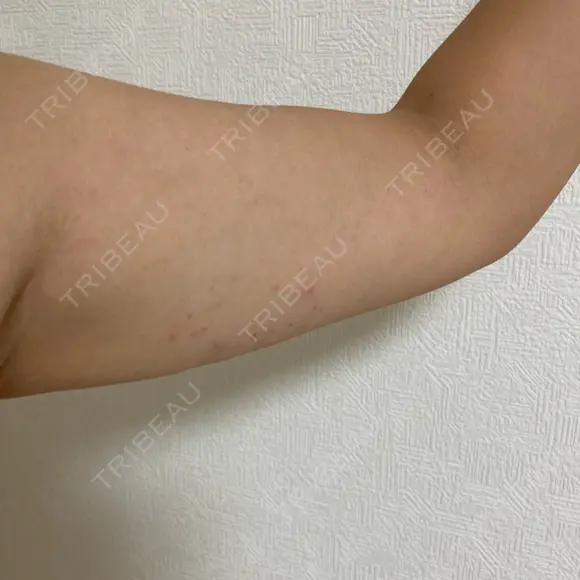 脂肪溶解注射（二の腕） 石倉クリニック 水戸院 DAY 14 メイン用