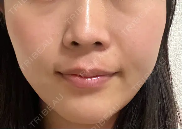 小鼻縮小（非切開） AI Beauty Clinic （エーアイ美容クリニック） DAY 11 メイン用