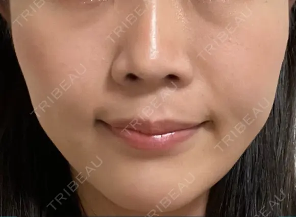 小鼻縮小（非切開） AI Beauty Clinic （エーアイ美容クリニック） DAY 10 メイン用