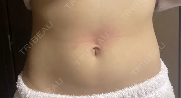 脂肪冷却（お腹） AI Beauty Clinic （エーアイ美容クリニック） DAY 14 メイン用