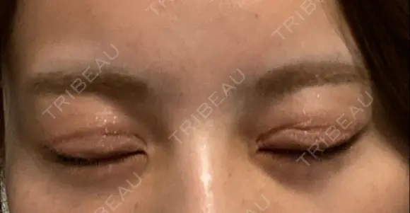 二重切開 / 眼瞼下垂（切開） / 目尻切開 / 上まぶたの脂肪取り / タレ目形成・グラマラスライン（切開） id（アイディ）美容外科 DAY 23 メイン用