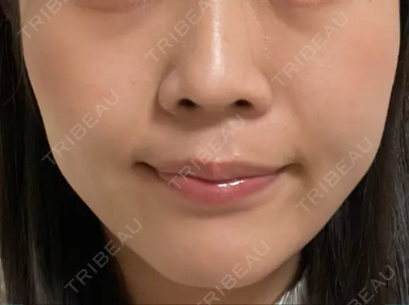 小鼻縮小（非切開） AI Beauty Clinic （エーアイ美容クリニック） AFTER メイン用