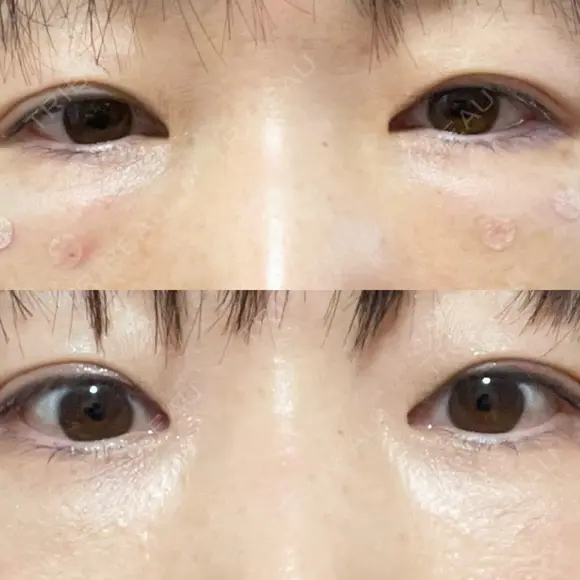 クマ治療 / 脂肪注入（肌） / ボトックス（あご） 銀座みゆき通り美容外科 大阪梅田院 DAY 32 メイン用