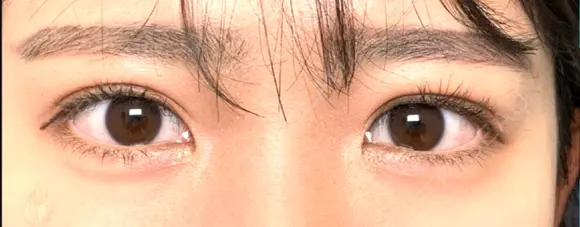 二重埋没 湘南美容クリニック 金沢院 AFTER メイン用