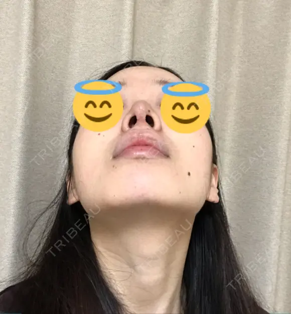 鼻尖形成（切開） / 軟骨移植 JUN CLINIC DAY 14 メイン用