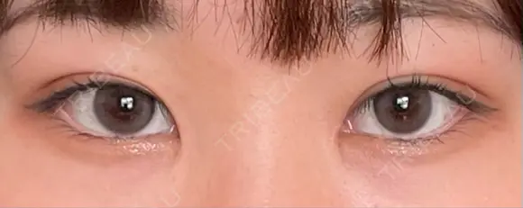 二重埋没 / 目頭切開 藤・ナチュレ美容クリニック 銀座院 DAY 37 メイン用