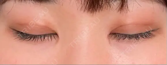 二重埋没 / 目頭切開 藤・ナチュレ美容クリニック 銀座院 DAY 37 メイン用