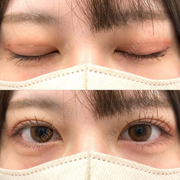 二重埋没 NARU Beauty Clinic 【ナルクリ】 AFTER メイン用
