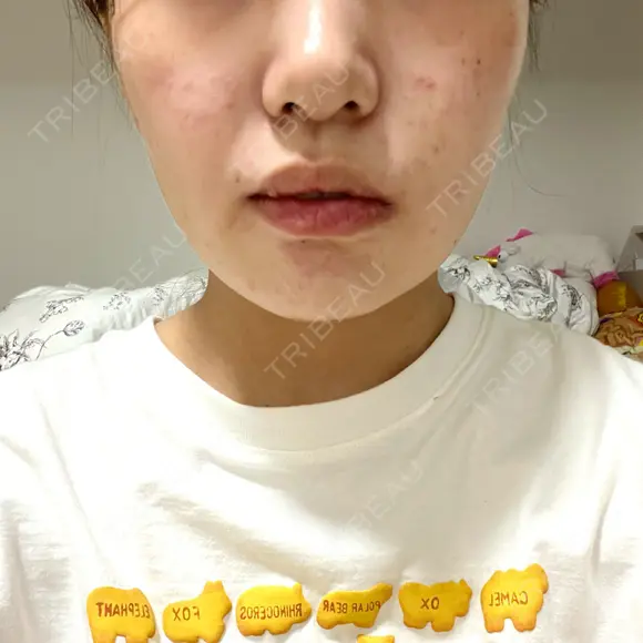 糸リフト / バッカルファット除去 / 脂肪吸引（顔） 湘南美容クリニック 京都院 DAY 14 メイン用