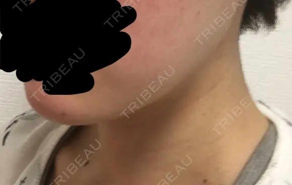 脂肪溶解注射（顔） / PRP皮膚再生療法 聖心美容クリニック 六本木院 DAY 12 メイン用