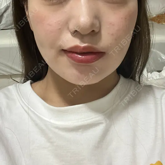 糸リフト / バッカルファット除去 / 脂肪吸引（顔） 湘南美容クリニック 京都院 DAY 16 メイン用