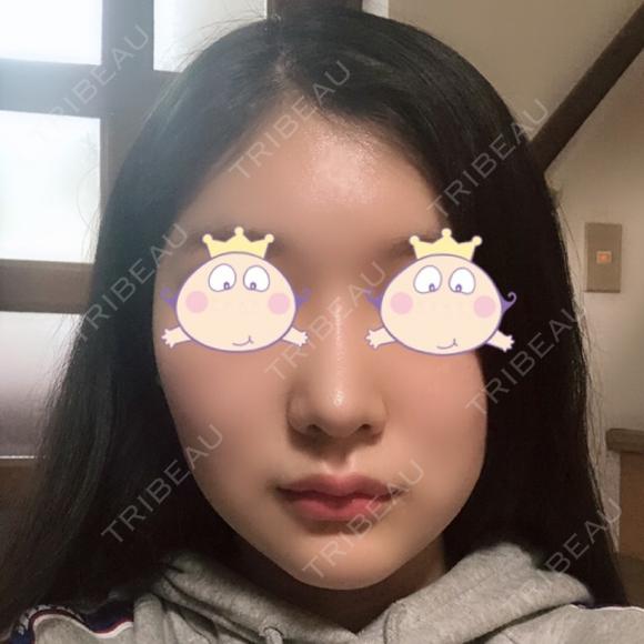隆鼻術 / 鼻尖形成（切開） / 鼻中隔延長（切開） / 小鼻縮小（切開） / プロテーゼ除去 / 鼻尖縮小 FROM B整形外科 (旧バウム整形外科) DAY 47 メイン用