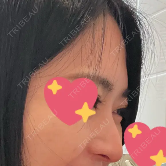 鼻尖形成（切開） / 鼻中隔延長（切開） / 鼻尖縮小 / 鼻柱下降・鼻唇角形成（猫手術） KAUNIS CLINIC（カウニスクリニック） DAY 37 メイン用