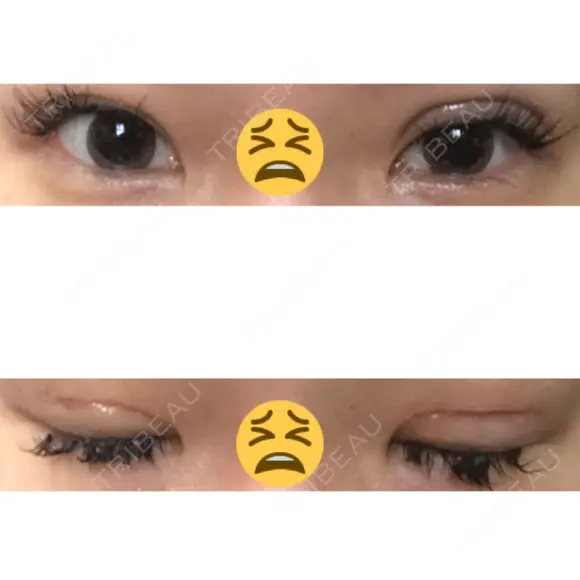 眼瞼下垂（切開） ピュア形成外科医院 DAY 16 メイン用