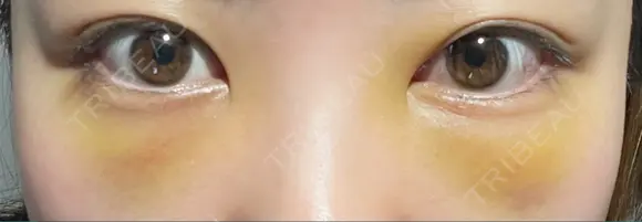 クマ治療 / 下まぶたたるみ取り / 下まぶたの脂肪取り APOLLO BEAUTY CLINIC DAY 3 メイン用