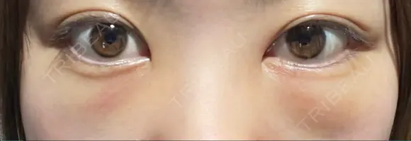 クマ治療 / 下まぶたたるみ取り / 下まぶたの脂肪取り APOLLO BEAUTY CLINIC DAY 2 メイン用