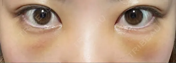 クマ治療 / 下まぶたたるみ取り / 下まぶたの脂肪取り APOLLO BEAUTY CLINIC DAY 2 メイン用