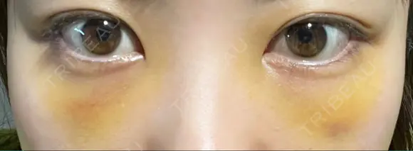 クマ治療 / 下まぶたたるみ取り / 下まぶたの脂肪取り APOLLO BEAUTY CLINIC DAY 4 メイン用