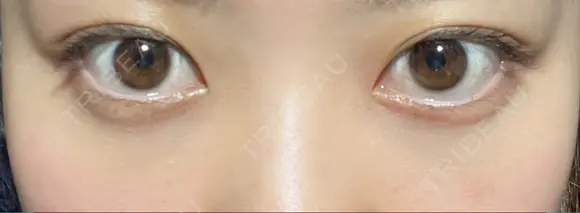 クマ治療 / 下まぶたたるみ取り / 下まぶたの脂肪取り APOLLO BEAUTY CLINIC DAY 10 メイン用