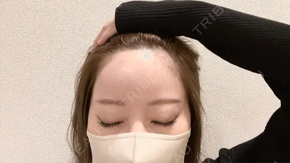 ヒアルロン酸注入（額） / ヒアルロン酸注入（こめかみ） 渋谷美容外科クリニック 新宿院 AFTER メイン用