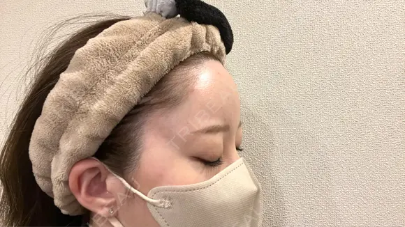 ヒアルロン酸注入（額） / ヒアルロン酸注入（こめかみ） 渋谷美容外科クリニック 新宿院 DAY 0 メイン用