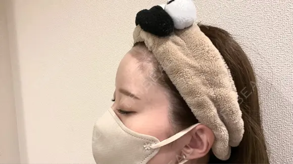 ヒアルロン酸注入（額） / ヒアルロン酸注入（こめかみ） 渋谷美容外科クリニック 新宿院 DAY 0 メイン用