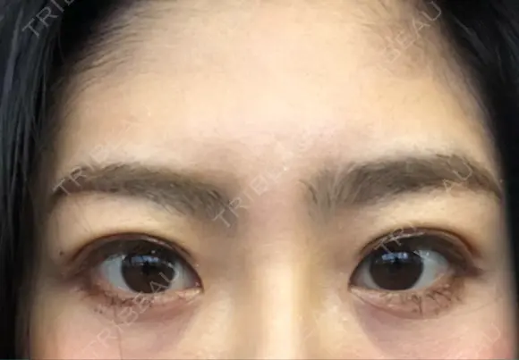 二重埋没 湘南美容クリニック 品川院 DAY 19 メイン用