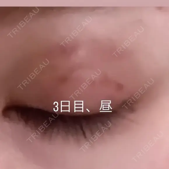二重埋没 湘南美容クリニック 那覇院 DAY 3 メイン用