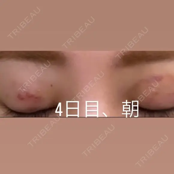 二重埋没 湘南美容クリニック 那覇院 DAY 4 メイン用