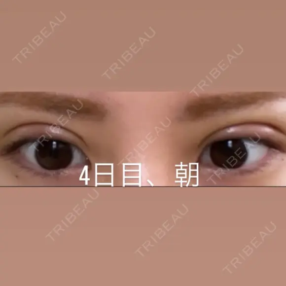 二重埋没 湘南美容クリニック 那覇院 DAY 4 メイン用